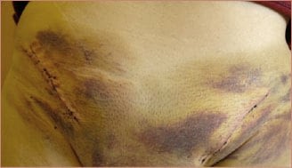 hernia surgery